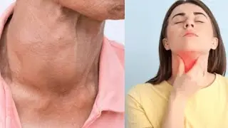 ACUPUNCTURE FOR HARD, NODULAR GOITER (PHLEGM & BLOOD STASIS)