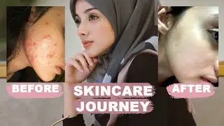 skincare routine (acne fighter)