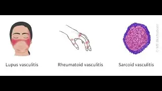 Vasculitis (Inflammation of Blood vessels) ; Causes, Symptoms, Diagnosis, Treatment
