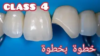حشوة كومبزت كلاس ٤ composite restoration cl.4