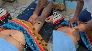 l4 l5 disc bulge treatment without surgery  acupuncture therapy