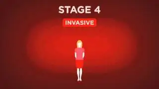 Beyond The Shock - Chapter 5 -  Types & Stages - Stage 4 Breast Cancer