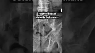 Paget&rsquo;s disease of the pelvis #xray #bones #anatomy