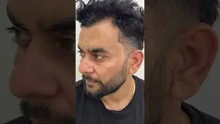 Best Pigmentation Result| Melasma Treatment | Crystal Skin Treatment | MedRootz Clinics #skincare n
