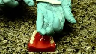How To Care For Your Removable Night Time Essix Retainer