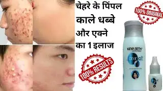 Keya Seth Clear Anti Off Pimple Face &Pack । Pimple Removal Face Pack At Home।@ShabanaJahan-941