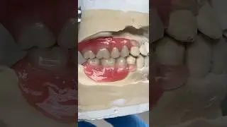 Cast Metal Try-Ins with Clear Clasps #lsk121shorts #dentistry #teeth