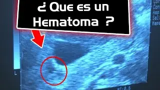Que es un hematoma en el embrazo, me dijeron que tengo un hematoma en el eco