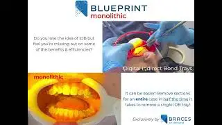 Braces On Demand - Monolithic vs. Digital Indirect Bonding With Trays