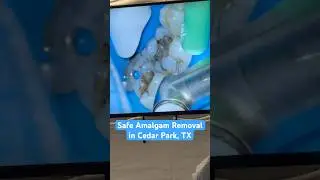 Safe Amalgam Filling Removal | Mercury-Free Dentistry in Cedar Park, TX