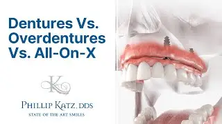 Dentures Vs Overdentures Vs All-On-X