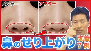 【鼻孔縁下降】鼻の縁のせり上がりが改善！症例写真一挙7例ご紹介
