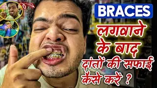 Braces लगवाने के बाद दाँत कैसे साफ करें | How To Clean Your Teeth After Getting Braces | #braces 