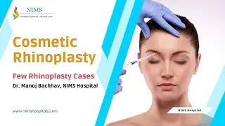 Cosmetic Rhinoplasty by Dr. Manoj Bachhav, NIMS Hospital |  Case Results