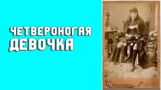 Четвероногая девочка Жозефина Миртл Корбин