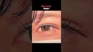 Bigger, Brighter Eyes &ndash; Double Eyelid Surgery Before & After