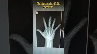 x ray hand #xray #xraytechnician #viralvideo #digitalimaging #medicalimageprocessing #2024 #viral