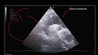 4 minutes on Suprasternal notch