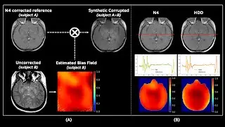 [S121] Bias Field Correction in MRI With Hampel Noise Denoising Diffusion Probabilistic Model