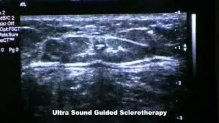 Ultra Sound Guided Sclerotherapy