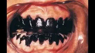 Wilkins Chapter 22: Dental Stains and Discolorations