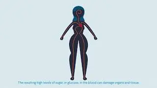Diabetes Mellitus  & its complications. #diabetesawareness #fyp #trending #foryou #diabtes 