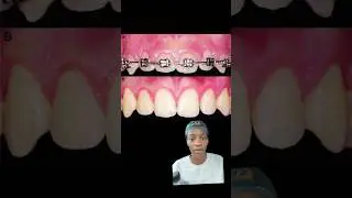 Insane results of a gingivectomy! #dentistry #dentist #teeth #gums
