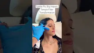 Small Enhancements, Big Impact: Temple Filler Transformation! 💉 #temple #filler