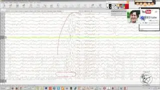 107 Quando uma descarga é epiléptica?