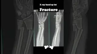 X ray hand ap lat | radiology |#xray #xraytechnicians #radiology #shorts #xraymachines #xraytech