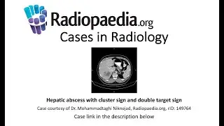 Hepatic abscess with cluster sign and double target sign (Radiopaedia.org) Cases in Radiology