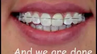 How to put ceramic braces? - MyDentCart | Ceramic Orthodontic brackets | Invisible Braces