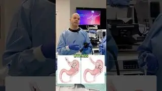 TORe: A Second Chance After Gastric Bypass