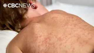 Here are Quebec's measles exposure sites as new cases reported