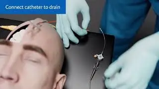 CereLink In-Service: Dual Placement Technique (2024)