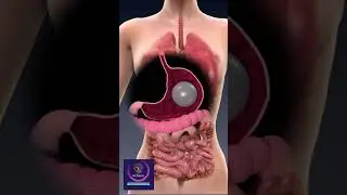 insertion of the gastric balloon for weight loss