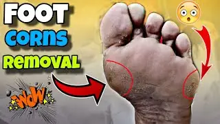 Professionally Foot Corn Removal / Super Scraps dead skin on feet 🤯