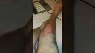 Artificial turf burn