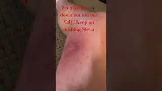 #spider #spiderbite #centraltexas #downnotout #hemmedup #dammitboy #illbeback #ouchthathurt #itchy