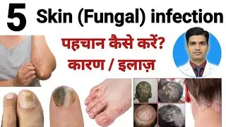 Skin infection : लक्षण, प्रकार तथा इलाज़ । Fungal infection types treatment