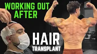 FUE Hair Transplant: How Long Should You Wait to Work Out After the Surgery?