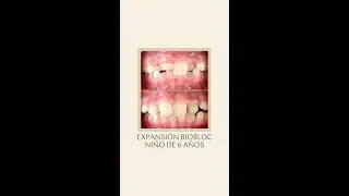 Caso ni&ntilde;o de 6 a&ntilde;os tratado con Biobloc