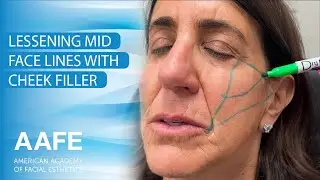 Lessen Mid-Face Lines with Cheek Filler