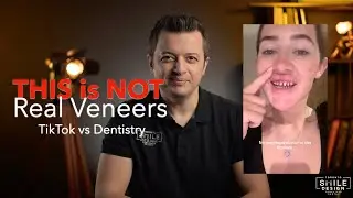 Porcelain Veneers Without Teeth Shaving? The Truth About No-Prep & Prepless Veneers