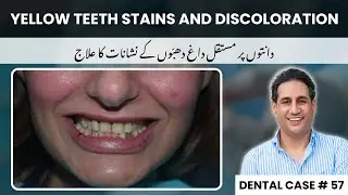 Teeth Stains and Discoloration Fixed With Composite Veneers | Yellow Teeth | Dental Case # 57