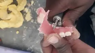 LOCALLY MADE PARTIAL DENTURE  #trending #dentaltechnology #dentist #partialdentures