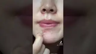 сними вместе со мной пластырь от прыщей.... (БОЛЬШОЙ ПРЫЩ) 🫣