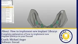 EXOCAD TUTORIAL - Dental-CAD/CAM- English Teaser -How to implement new implant Librarys