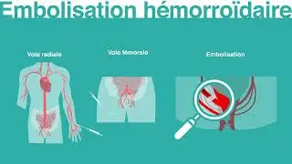 Hémorroïdes internes saignements , des solutions ?