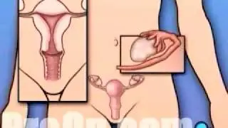 PreOp&reg; Patient Education Hysterectomy Removal of the Uterus 3